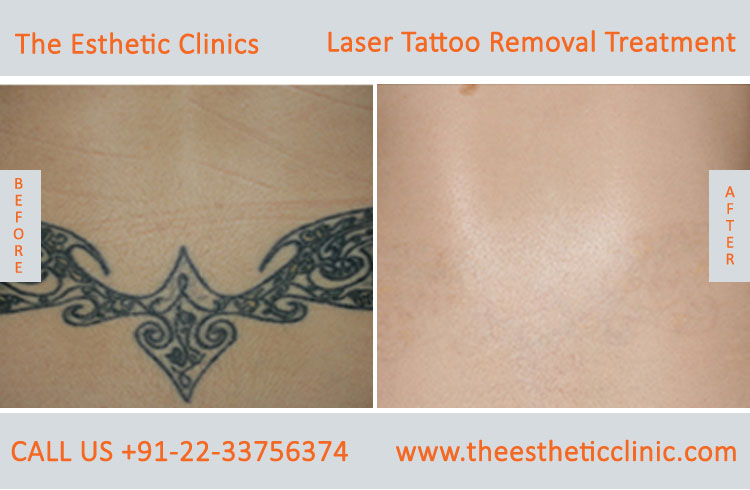 Permanent Laser Tattoo Removal Treatment before after photos in mumbai india (3)